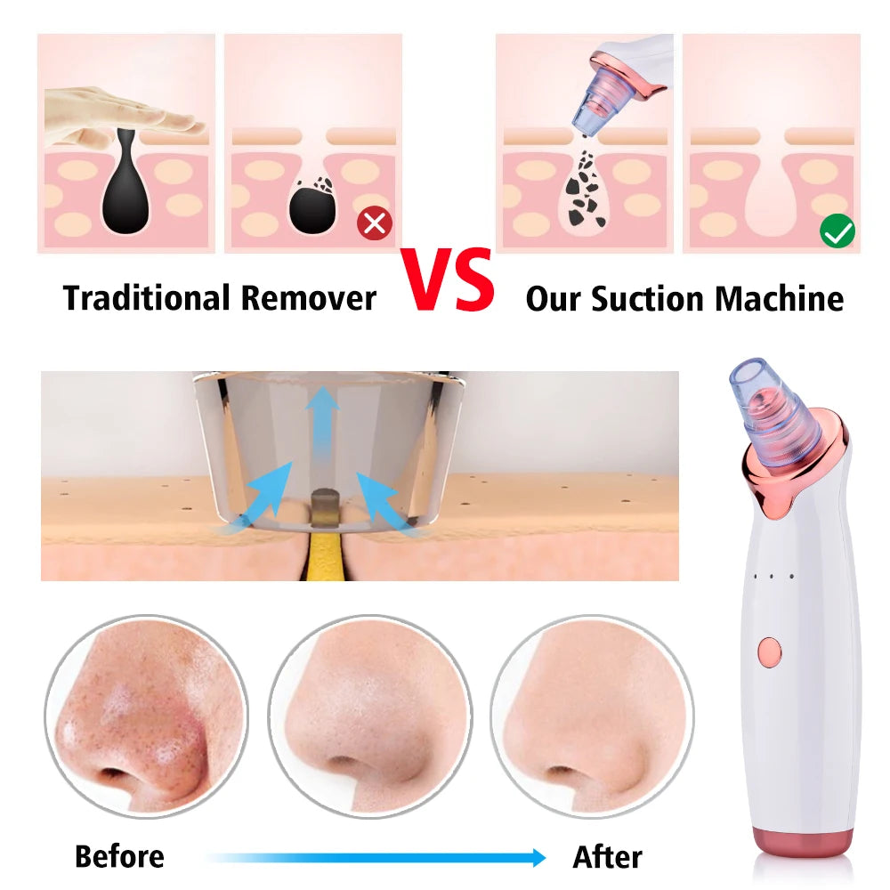 Aspirapolvere per la rimozione dei punti neri Naso elettrico Bellezza Viso Pulizia profonda Cura della pelle Aspirapolvere Macchie nere Detergente per pori dell'acne Strumento per brufoli